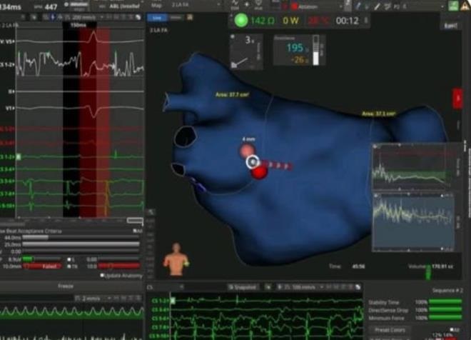Hôpital Sahloul: Premières ablations complexes par Rythmia au service de cardiologie