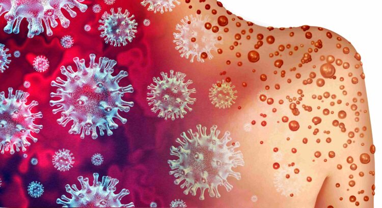 L'AHF : l'accès au vaccin contre la variole du singe doit être guidé par l'équité mondiale et l'inclusion