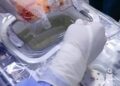 Première en Tunisie : LifePort utilisé pour une greffe de rein à l’hôpital Charles Nicolle