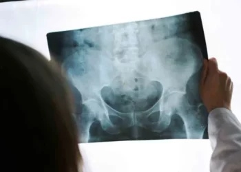 Ostéoporose en Tunisie: Une femme de plus de 45 ans sur quatre touchée