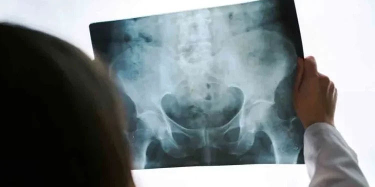 Ostéoporose en Tunisie: Une femme de plus de 45 ans sur quatre touchée
