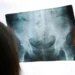 Ostéoporose en Tunisie: Une femme de plus de 45 ans sur quatre touchée